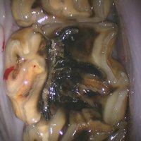 sagitale-fractuur-e1632260072357-768x620 sagitale-fractuur-e1632260072357-768x620